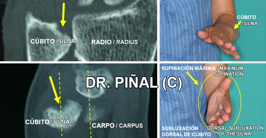 subluxación dorsal de cúbito