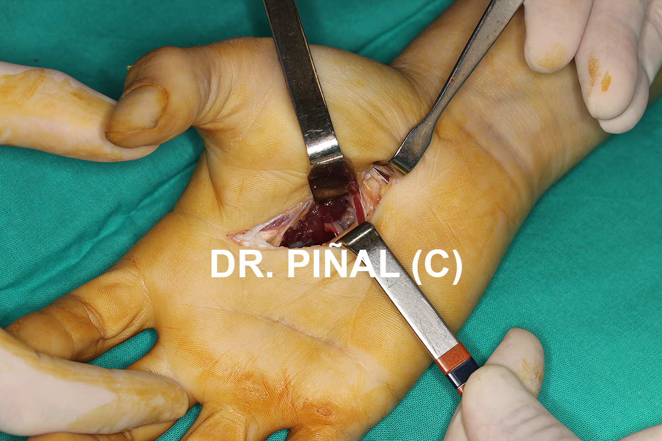 Release of the adductor muscle 