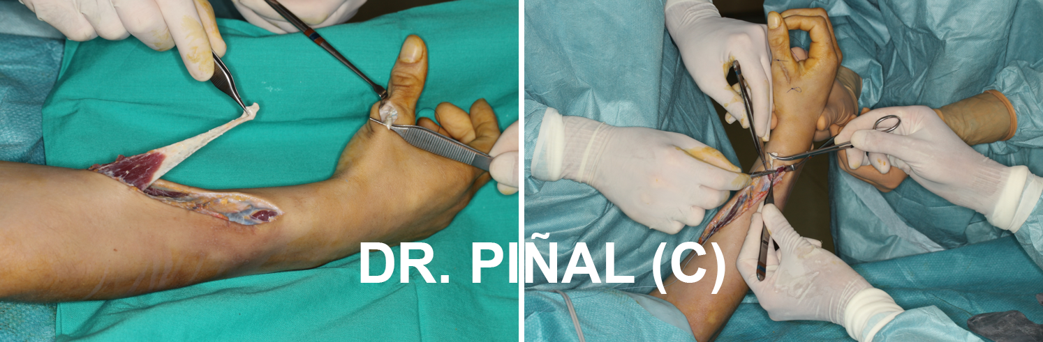 Tendon transfer