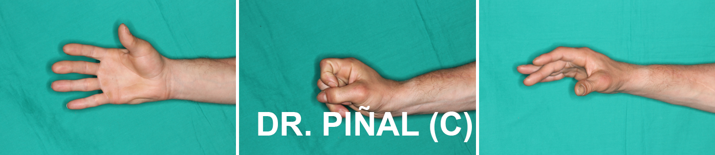 Thumb postoperative function 