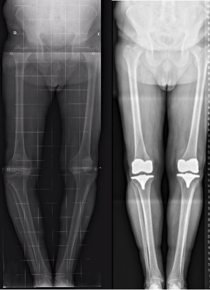 Gonartrosis en varo bilateral